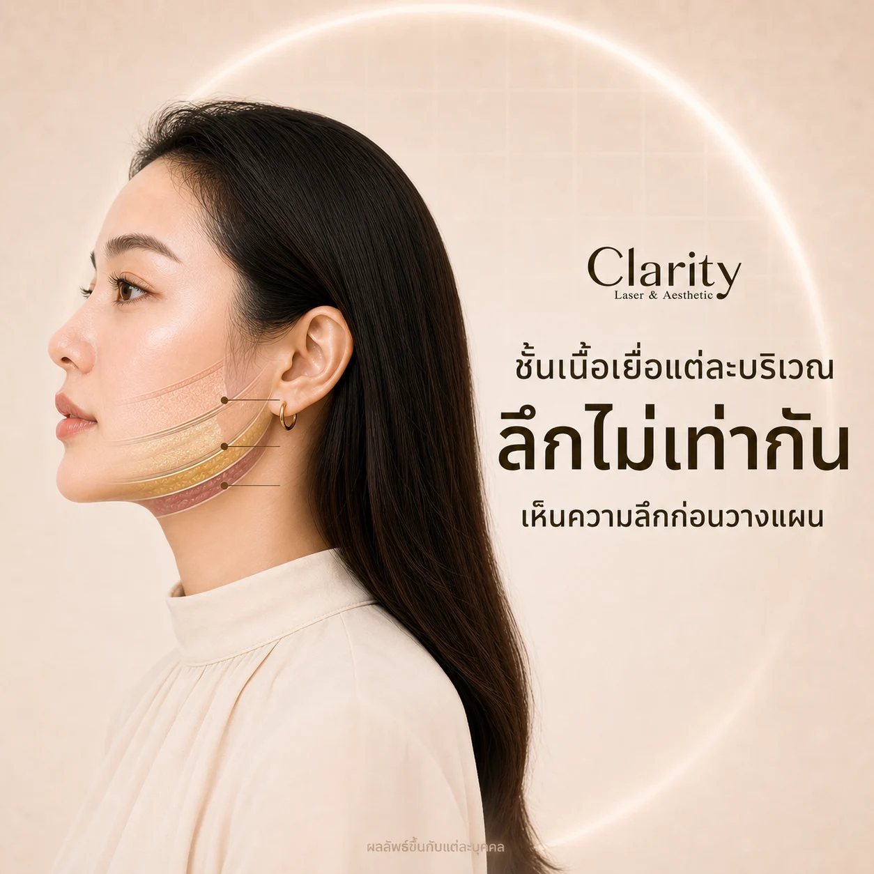 ภาพประกอบแนวคิด: ความลึกของชั้นเนื้อเยื่อแตกต่างกันตามบริเวณใบหน้า