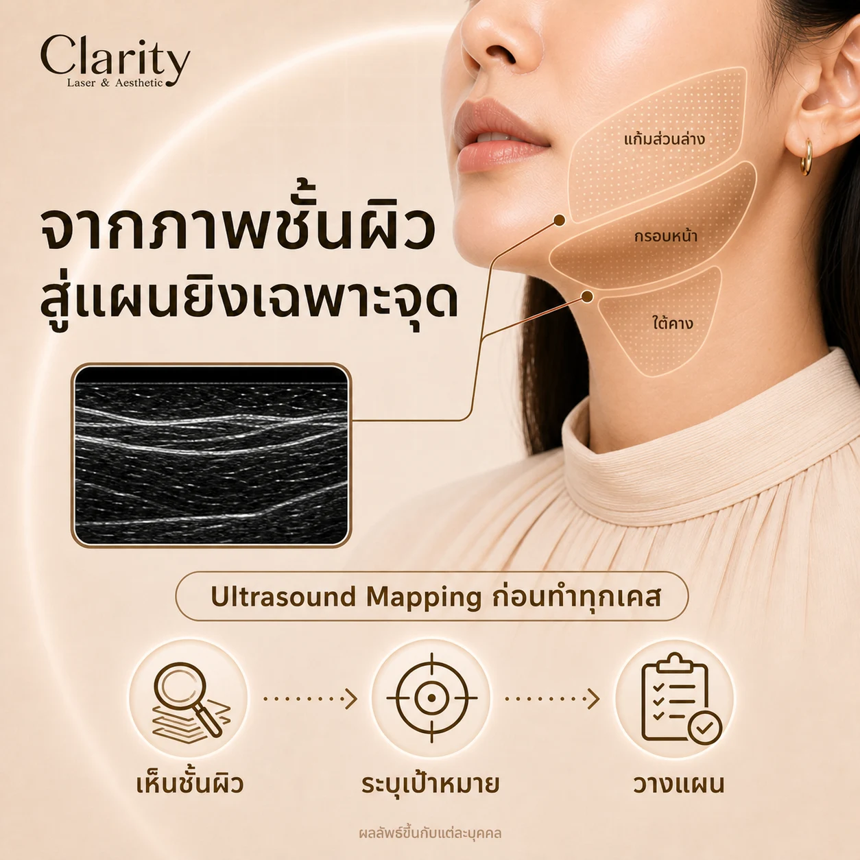 ภาพประกอบการวางแผน HIFU บริเวณแก้มส่วนล่าง กรอบหน้า และใต้คาง โดยใช้ข้อมูลจาก Ultrasound