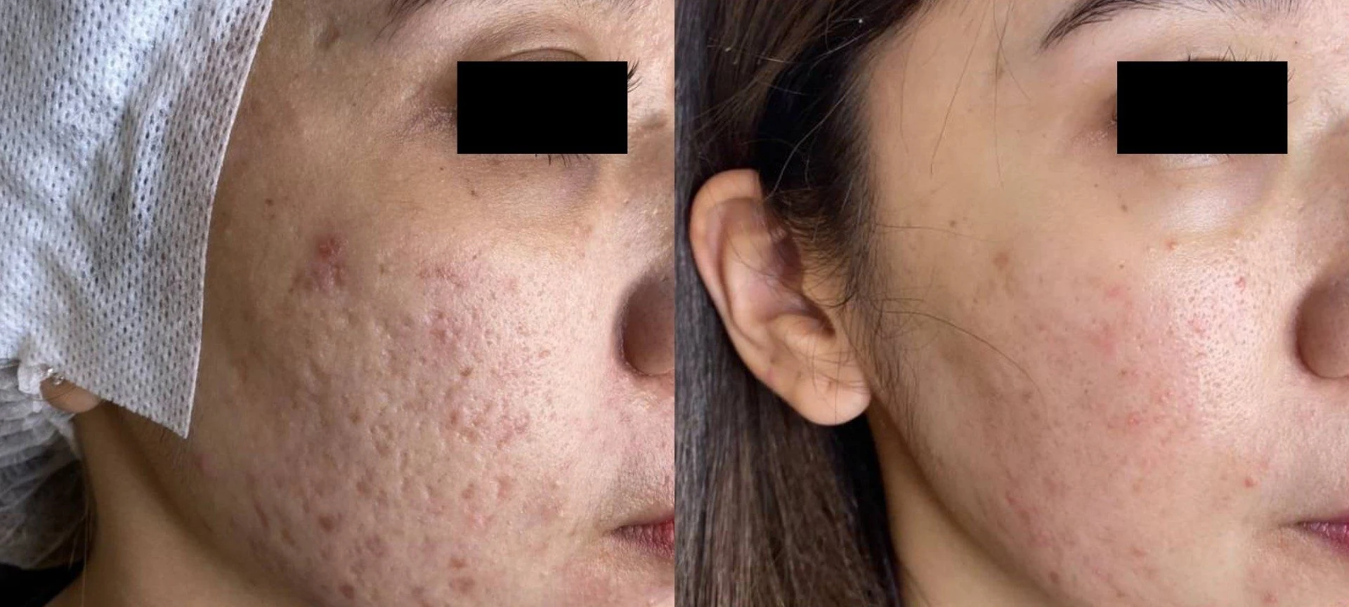 ภาพก่อน-หลังรักษาหลุมสิว เคส 01 · Mixed severe acne scar · หญิง · 27 ปี · 3 session — Clarity Clinic