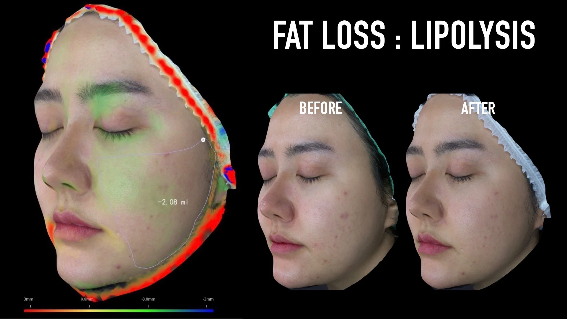 ภาพสแกนใบหน้า 3 มิติแสดงแผนที่ปริมาตร ร่วมกับภาพเปรียบเทียบก่อนและหลัง