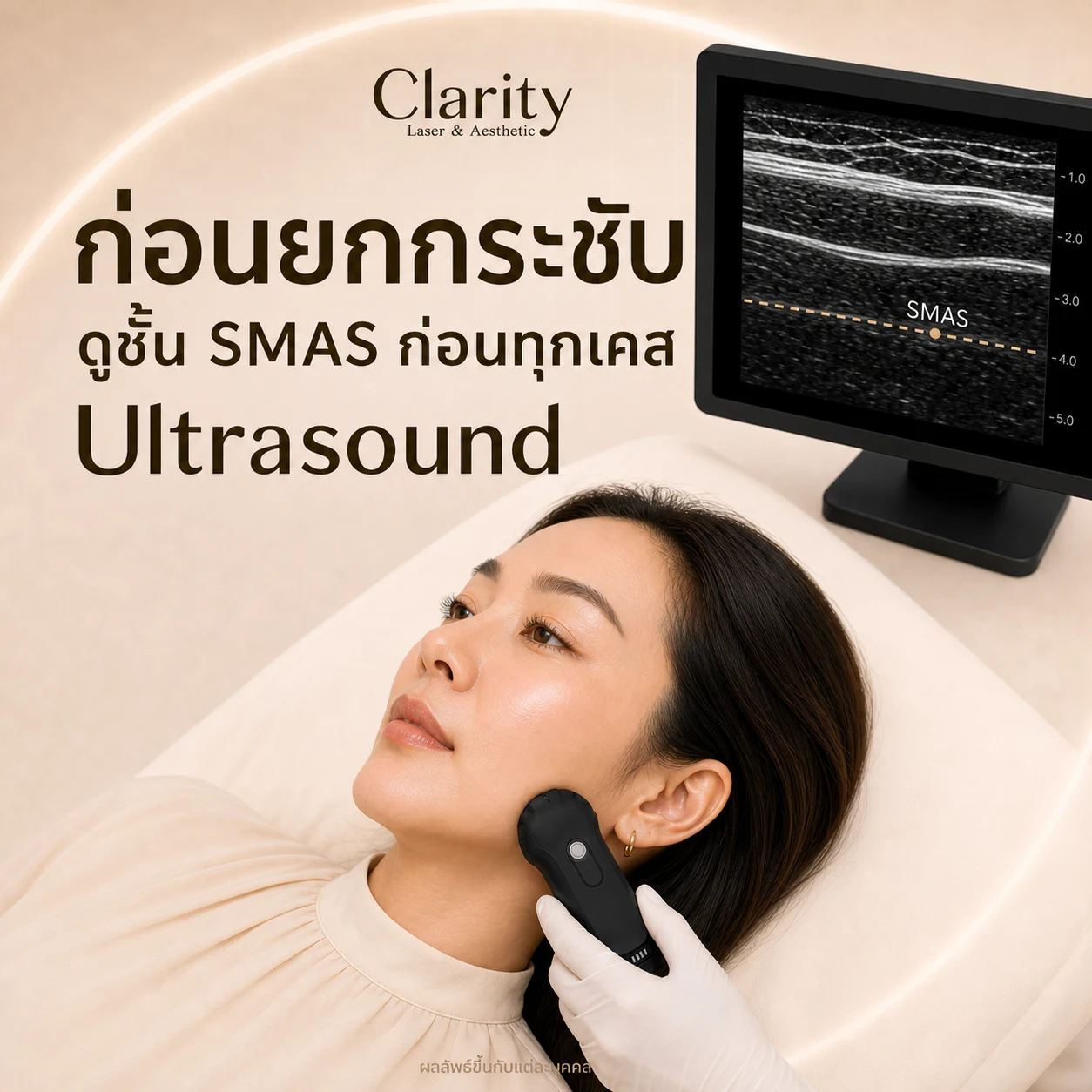 ภาพประกอบขั้นตอนตรวจ Ultrasound ประเมินชั้น SMAS ก่อนทำ HIFU
