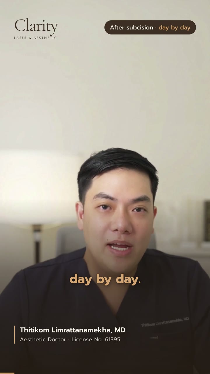 Subcision recovery, day by day — a 52-second summary
