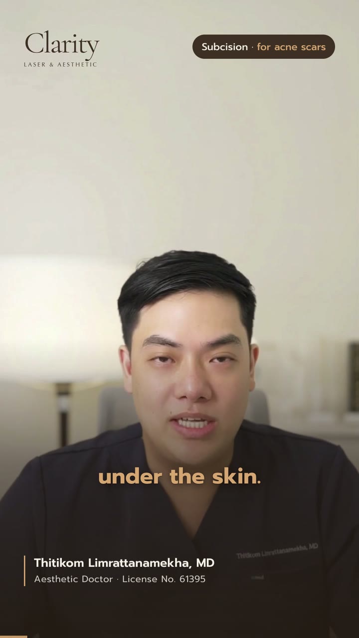 What is subcision for acne scars? A one-minute summary