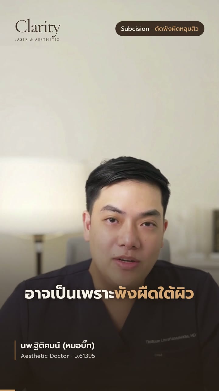 Subcision ตัดพังผืดหลุมสิว คืออะไร — สรุปใน 49 วินาที